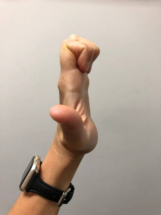 Tendon Gliding Exercises (Hand) Zen Physiotherapy